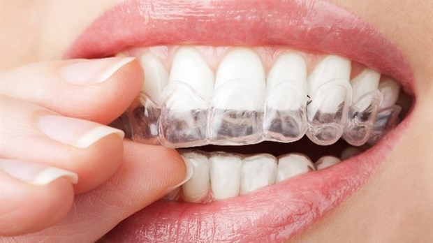 Les avantages du traitement Invisalign